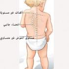 خاص| بالفيديو: أسباب تشوهات العمود الفقري وطرق الوقاية والعلاج