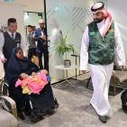 فصل التوأم الطفيلي المصري في السعودية: القصة كاملة بالفيديو والصور