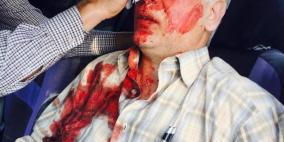 بالصور: اصابة مواطن اثر اعتداء مستوطنين عليه قرب نابلس