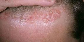 العدوى أبرز سبب للإصابة بالصدفية