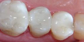 ابتكار حشوات أسنان أبدية