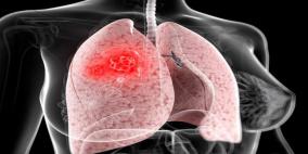 توقُّع ارتفاع وفيات النساء جراء سرطان الرئة بحلول 2030