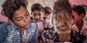 تعرّف على قصة "الطفل الذئب" في الهند