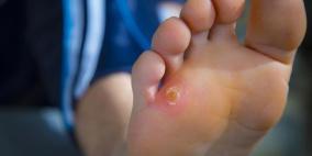 عين السمكة.. لماذا تنشأ وكيف يمكن مواجهتها؟