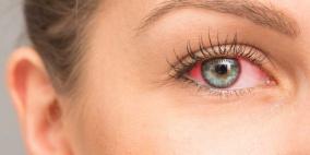 إلتهاب العين.. الاحمرار أول علامات المرض