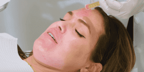 "بلازما الدم".. تقنية تجميلية لمحو آثار حب الشباب