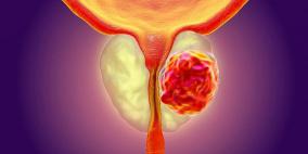 من الأفضل معرفتها..علامات تدل على الإصابة بسرطان البروستات