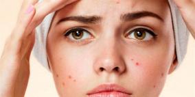 تناول هذا النوع من الطعام يعمل على ظهور "حب الشباب"