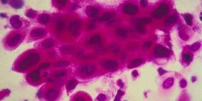  تقنية جديدة تنجح في قتل الخلايا السرطانية