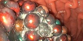 استخراج 209 كرات مغناطيسية من معدة طفل