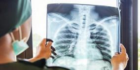 علامات تطور سرطان الرئة