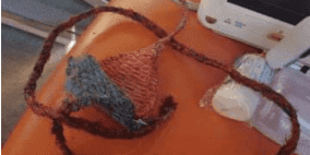 مقلاع أبو عياش