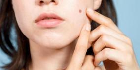 احذر.. بعض الشامات يمكن أن تكون قاتلة!