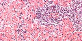 أطباء يكشفون عن "علاج" نجح في شفاء مرضى اللوكيميا!