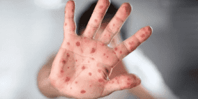 جدري القردة يتفشى في العالم.. دول تعلن إصابات مؤكدة