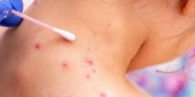 الصحة: لم تسجل أي إصابة بجدري القردة في فلسطين حتى الان