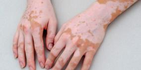 نتائج ثورية لأول علاج لمرض البهاق.. كيفية الاستخدام