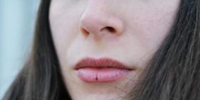 أربع أسباب صحية مقلقة وراء تشقق الشفاه