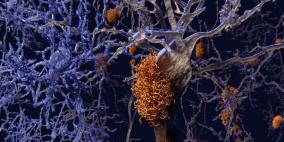 عقار ألزهايمر "الواعد" يفشل في تحقيق أهدافه ويبدد آمال العلماء