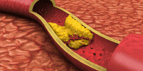 خبير تغذية يكشف المواد الغذائية الغنية بالكولسترول "الضار"