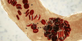 عامل مفاجئ يزيد من خطر الإصابة بتجلط الدم