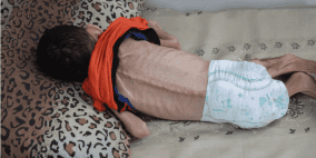 6 وفيات نتيجة التجويع في غزة خلال الساعات الـ24 الماضية