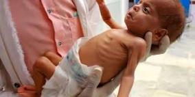 وفاة طفلة في مدينة غزة نتيجة المجاعة وسوء التغذية