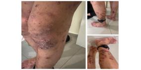 تحقيق لـ"هآرتس": ربع الأسرى أصيبوا بمرض الجرب مؤخرا