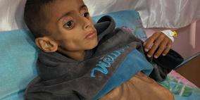 الصحة العالمية: سوء التغذية يهدد حياة الأطفال بغزة