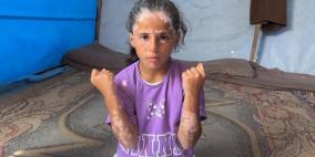 أطفال غزة نموذج مؤلم.. هذه أبرز الأمراض الجلدية الناتجة عن الخوف والصدمات!
