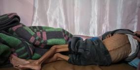 وفاتان إحداهما طفل نتيجة التجويع وسوء التغذية في غزة