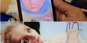 وفاة طفلة عام ونصف بسبب سوء التغذية في دير البلح