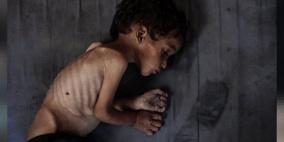 "أوتشا": تفاقم المجاعة وسوء التغذية وأزمة المأوى في قطاع غزة