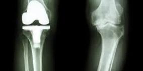 زراعة المفاصل الصناعية: حلٌ طبيّ يُعيد الحياة بلا ألم