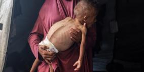 وفاة طفلين بسبب المجاعة وسوء التغذية في غزة