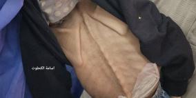 غزة: 3 وفيات بالتجويع آخر 24 ساعة والحصيلة ترتفع إلى 162 شهيدا
