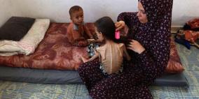 10 وفيات بينها 3 أطفال نتيجة التجويع في غزة خلال الساعات الماضية