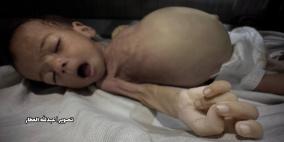 الأمم المتحدة تطالب بعمل دولي عاجل لوقف الوفيات في غزة