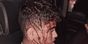 اعتداء وحشي في خلة الضبع: 20 مصابا بينهم رضيع بهجوم للمستوطنين