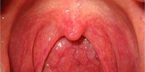 ما هو علاج احتقان الحلق؟