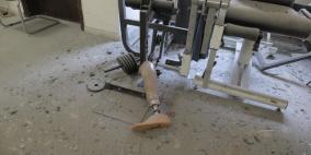 خاص| قصف الاحتلال يتسبب بتوقف مركز الأطراف الصناعية في غزة ويضاعف معاناة الجرحى