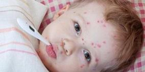 خاص | "الجدري" بين الوقاية والمضاعفات: طبيب يقدّم نصائح للأهالي