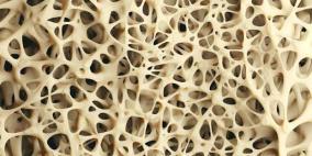 في اليوم العالمي لهشاشة العظام: د. خليل عيسى يوضح لراية أسباب المرض الصامت وطرق الوقاية والعلاج