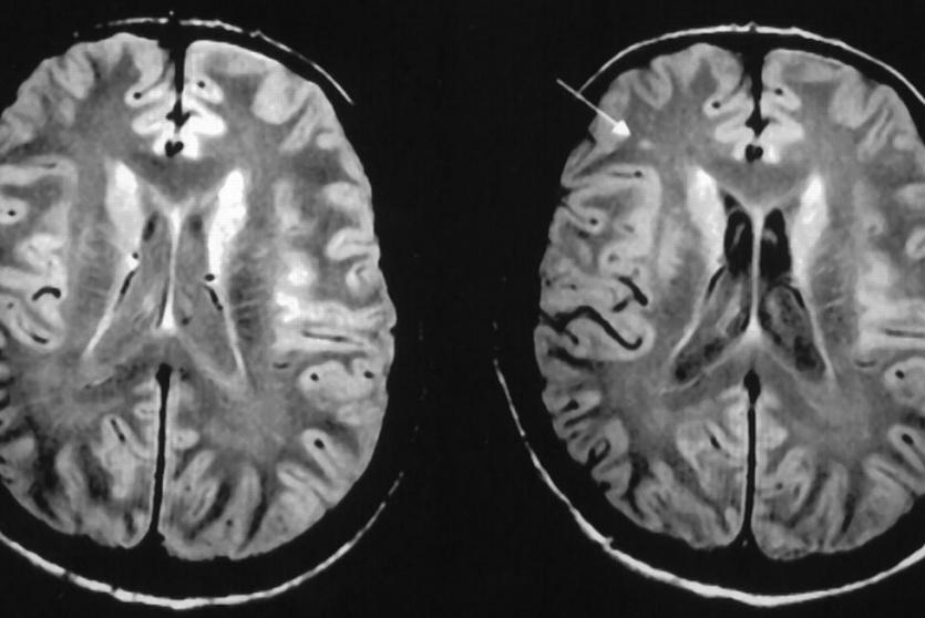 المادة البيضاء في الدماغ