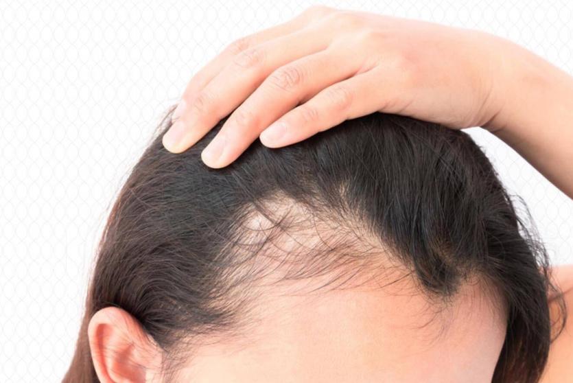 الصلع النمطي - توضيحية 