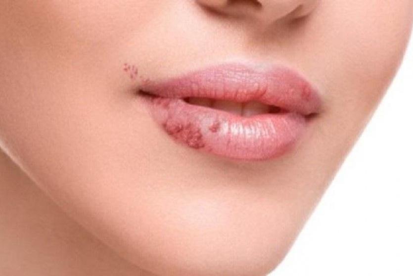 تشقق الشفاه