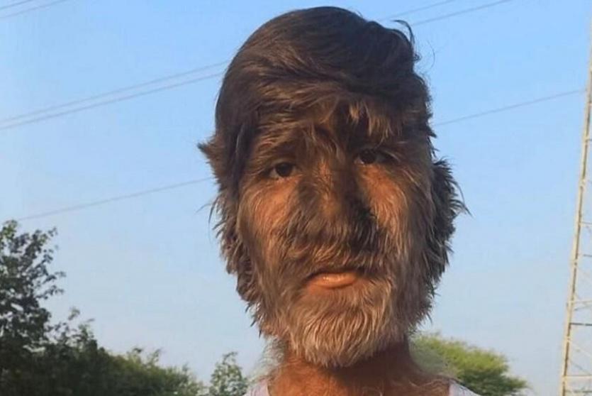 هندي يدخل موسوعة غينيس بسبب كثافة شعر وجهه 