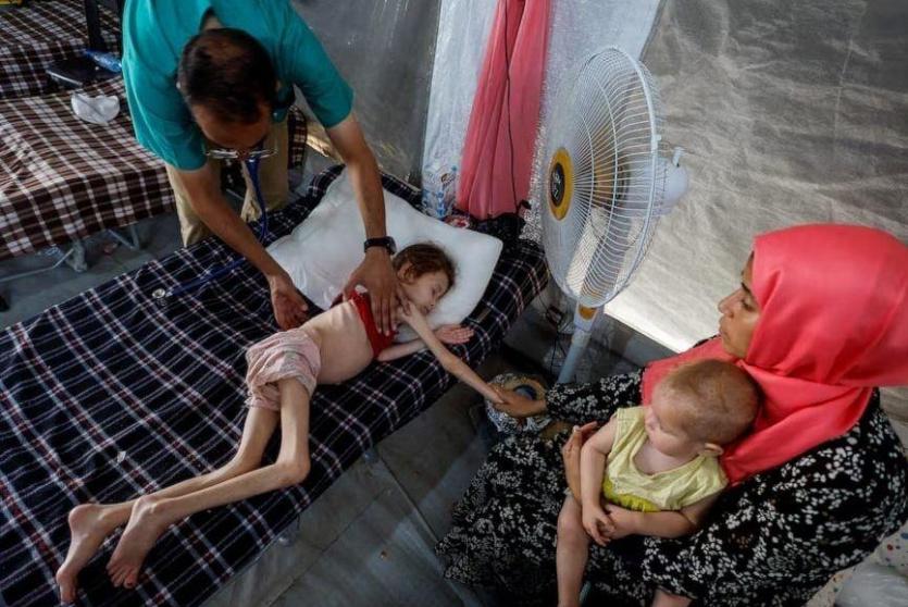 طفلة تعاني من سوء تغذية في غزة