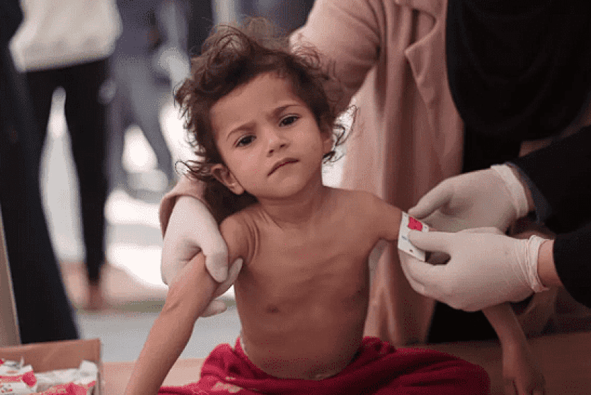 طفلة مصابة بسوء تغذية في غزة - ارشيف