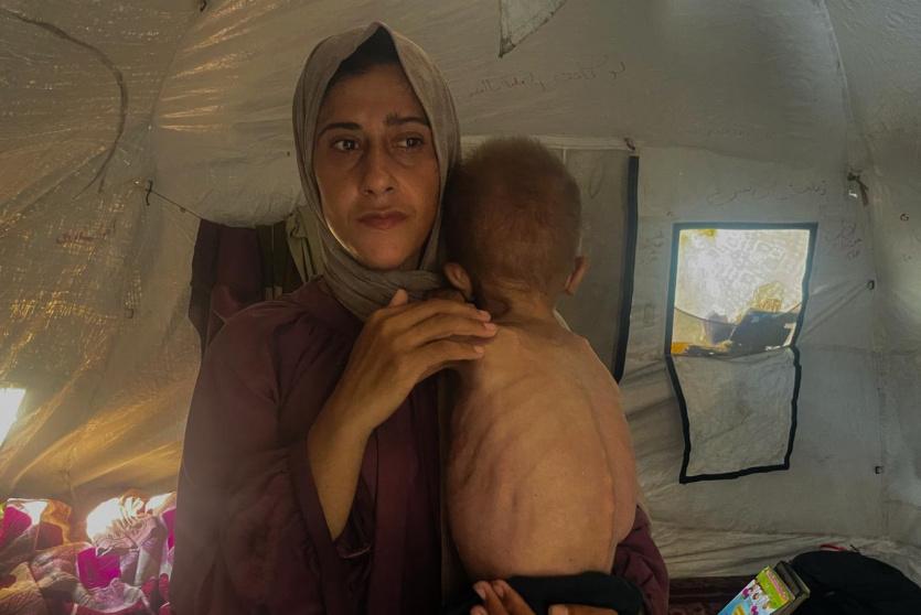 طفل يعاني من سوء تغذية